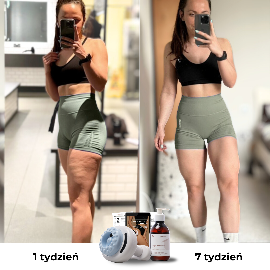 Masażer antycellulitowy CuppingPro™